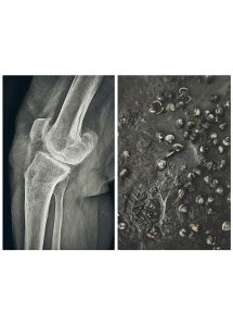 gonarthrose 4 1 TER_1600PX